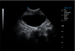 Bladder – Micro-Convex Probe, Cross-Sectional View